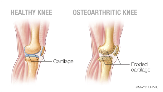 a medical illustration of a healthy knee joint and one with osteoarthritis