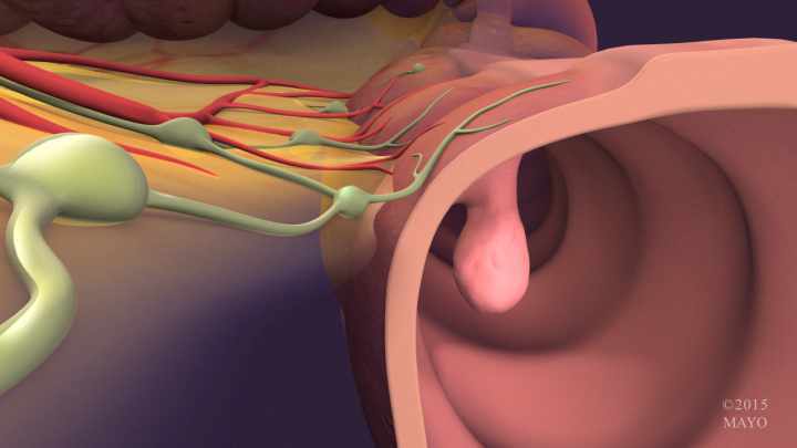 Colon cancer polyp illustration