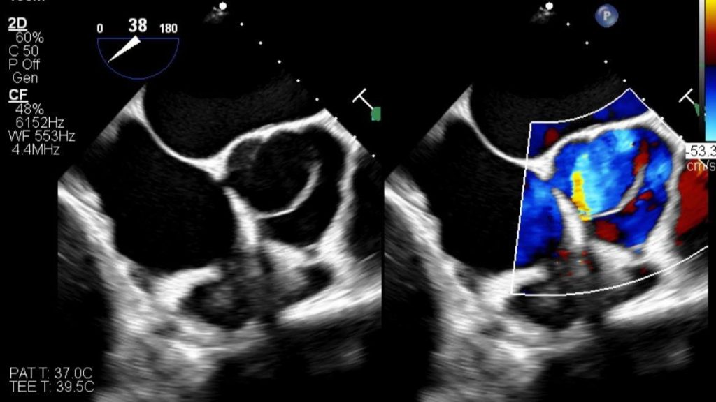 transoesophageal echo image showing a bicuspid aortic valve with evidence of mild regurgitation, or leaking